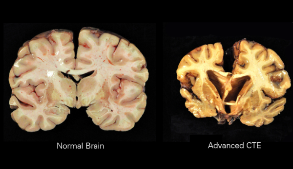 Chronic_Traumatic_Encephalopathy - Seven Pillars Institute